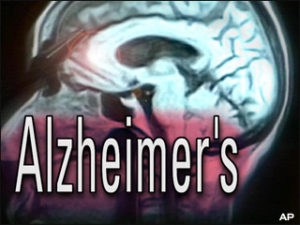 Alzheimer-kór tünetei